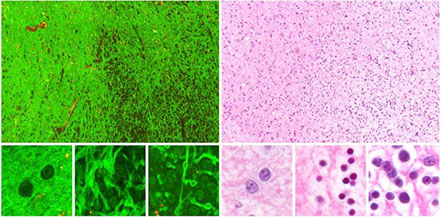 Third-Harmonic Generation Microscopy Provides In Situ Brain Tumor Imaging